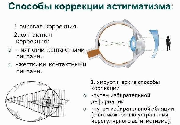 Астигматизм. Понятие и характеристика